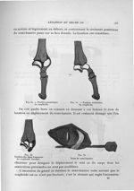 Fig. 50. Position postérieure du scaphoïde / Fig. 51. Position antérieure du scaphoïde / Fig. 52. Po [...]