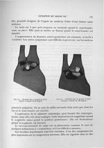 Fig. 61. Position des os quand le semi-lunaire a tourné de 90 degrés / Fig. 62. Position des os quan [...]