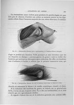 Fig. 63. Interposition fibreuse (pièce expérimentale) / Fig. 64. Interposition fibreuse - Exposé des [...]