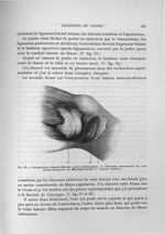 Fig. 66. Interposition musculo-fibreuse (pièce pathologique) - Exposé des travaux scientifiques