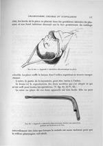 Fig. 67 bis. Appareil à inhalation chloroformique en place / Fig. 68. Appareil à inhalation chlorofo [...]