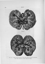 Fig. 92 / Fig. 93. Coupe médio-frontale sur deux reins dont les veines sont injectées - Exposé des t [...]