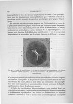 Fig. 98. Lésion du canal déférent - Exposé des travaux scientifiques