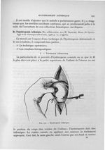 Fig. 102. Hystéropexie isthmique - Exposé des travaux scientifiques