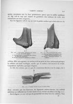 Fig. 108. Extrémité inférieure du radius vu par son bord cubital / Fig. 109. Face postérieure du rad [...]