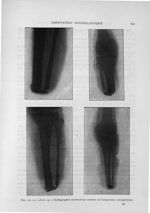 Fig. 116, 117, 118 et 119. Radiographies montrant les résultats de l'amputation ostéoplastique - Exp [...]