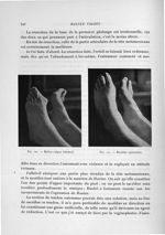 Fig. 120. Hallux valgus bilatéral / Fig. 121. Résultat opératoire - Exposé des travaux scientifiques