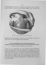 Fig. 30. Grossesse tubaire à terme, avec enfant mort - Titres et travaux scientifiques