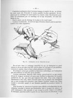 Fig. 19. Extirpation du sac. Dissection du sac - Exposé des titres et travaux scientifiques