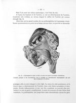 Fig. 2. Pyélonéphrite ayant récidivé au cours de quatorze grossesses consecutives - Titres et travau [...]