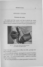 Fig. 2. Etat normal. Flexion des orteils provoquée par excitation de la plante du pied - Exposé des  [...]