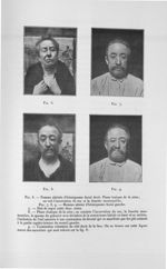 Fig. 6. Femme atteinte d'hémispasme facial droit/ Fig. 7, 8, 9. Homme atteint d'hémispasme facial ga [...]