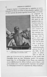 Fig. 12. Hémiplégie droite organique au cinquième jour. Flexion exagérée de l'avant-bras à droite -  [...]