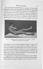 Fig. 14. Hémiplégie gauche organique un an après son début. Fléxion combinée de la cuisse et du tron [...]