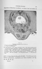 Fig. 27. [Coupe de la protubérance (syndrome bulbaire)] - Exposé des travaux scientifiques