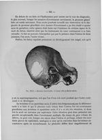 Fig. XLV. Grossesse interstitielle : la tumeur telle qu'elle fut enlevée - Titres et travaux scienti [...]