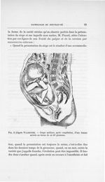 Fig. 2 (d'après Waldeyer). - Coupe médiane, après congélation, d'une femme arrivée au terme de sa 10 [...]