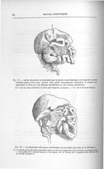 Fig. 72. Après dissection on reconnaît que la masse sous-hépatique sur laquelle s'arrête l'intestin  [...]