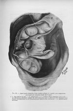 Fig. 101. Aspect après dissection d'une coudure colique (1re variété) avec mégacaecum provoquée par  [...]