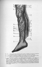 Fig. 161. Photographie d'une dissection d'un membre variqueux sur lequel on avait fait une résection [...]