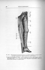 Fig. 162. Photographie d'une dissection faite sur un membre variqueux sur lequel on avait un an aupa [...]