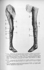 Fig. 163. Photographie d'une dissection faite sur un membre variqueux où on avait fait un an auparav [...]