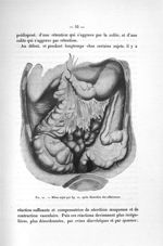 Fig. 21. Même sujet que fig. 20, après dissection des adhérences - Titres et travaux scientifiques