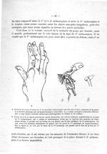 A. Nodosité du pouce et pouce en Z / B. Pouce en Z de la figure précédente après dissection - Titres [...]