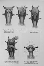 Fig. 16. Dissection de la lèvre externe de l'incision (le lambeau-sac est supposé encore en place, p [...]