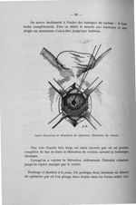 Après dissection et dilatation du sphincter, libération du rectum - Titres et travaux scientifiques