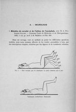 Fig. 1. Etat normal, pas de catalepsie / Catalepsie cérébelleuse (Babinski) - Exposé des titres et t [...]