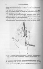 Fig. 18. Le lambeau palmaire recouvre le flanc de l'annulaire. Dissection d'un lambeau sur la face d [...]