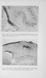 Fig. 15. Obs. Ak... H., 25 ans. Syndrôme hébéphréno-catatonique ; 10 mois après, délire aigu. Mort l [...]