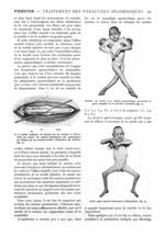 Fig. 1. - La 5e racine lombaire est chargée sur un crochet et l'intervalle qui sépare les racines an [...]