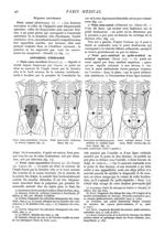 Fig. 13. - Point costo-musculaire (Guyon, Le Dentu, Legueu) / Fig. 14. - Point sous-costal (Albarran [...]