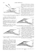 Fig. 4. - Dissection de la cicatrice adhérente aux tendons extenseurs englobés dans du tissu fibreux [...]