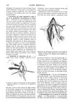 Fig. 3. - Le cordon est chargé sur l'index gauche et étalé / Fig. 4. - Ligature du sac ; l'index gau [...]