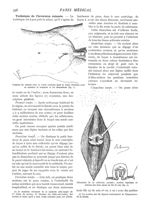 Fig. 1. - Position du malade avec la sonde cannelée dans le trajet fistuleux pour en mesurer la long [...]