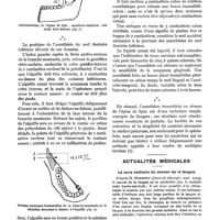 0218 - Page 194 - Indications et technique de l'anesthésie tronculaire du nerf dentaire inférieur, par le Dr J. Bercher / Actualités médicales. La cure radicale du cancer de la langue