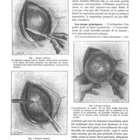0054 - Page 50 - Ma technique de l'extirpation des goitres. Technique opératoire, par Pierre Sebileau. Les temps préparatoires / Les temps principaux