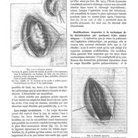 0057 - Page 53 - Ma technique de l'extirpation des goitres. Technique opératoire, par Pierre Sebileau. Les temps principaux / Les temps terminaux / Modifications imposées à la technique de la décortication par quelques états anatomiques