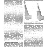 0061 - Page 57 - Ma technique de l'extirpation des goitres. Technique opératoire, par Pierre Sebileau. Modifications imposées à la technique de la décortication par quelques états anatomiques / Le pronostic des goitrectomies