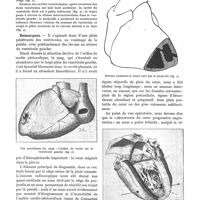 0081 - Page 77 - Un cas de plaie du coeur opérée. Mort par abondante hémorragie intrapleurale, par Jean Quénu / Remarques