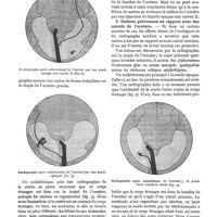 0117 - Page 113 - Diagnostic radiographique des calculs de l'uretère, par le Dr F. Arcelin. A. Ombres pelviennes non en rapport avec des calculs de l'uretère / B. Ombres pelviennes en rapport avec des calculs de l'uretère