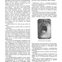 0505 - Page 497 - Sur un cas de tumeur mixte de la voûte palatine, par le Dr Négrié / Observation