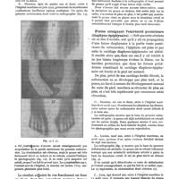 0421 - Page 405 - Tuberculose du premier métatarsien chez l'enfant, par E. Sorrel et J. Bouquier. Forme localisée à l'extrémité antérieure (métatarso-phalangienne) / Forme atteignant l'extrémité postérieure (diaphyso-épiphysaire)