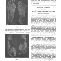 0423 - Page 407 - Tuberculose du premier métatarsien chez l'enfant, par E. Sorrel et J. Bouquier. Forme atteignant l'extrémité postérieure (diaphyso-épiphysaire) / Sociétés savantes. Société médicale des hôpitaux. Séance du 28 octobre 1921