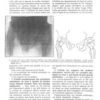 0080 - Page 68 - Les hanches congénitalement désaxées, par MM. G. Massabuau et L. Marchand / 1° L'étude morphologique des extrémités articulaires ne nous a permis de déceler aucun élément constant dans nos hanches malformées / 2° L'étude des rapports des surfaces articulaires étudiés par les procédés classiques ne nous a pas donné de plus grande satisfaction