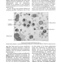 0068 - Page 56 - Les ponctions couplées des centres hématopoïétiques dans la splénomégalie érythroblastique chronique de l'adulte, par P. Émile-Weil et Suzanne Perlès. Ponction du foie