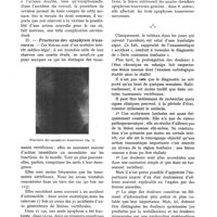 0426 - Page 408 - Réflexions sur les fractures vertébrales dans la pratique médico-légale (D'après 123 observations personnelles), par les Docteurs P. Mazel, P. Robin, R. Péchoux. I. - Tassement des corps vertébraux / II. - Fractures des apophyses transverses